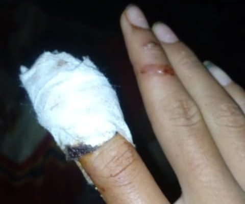 Siswa SMP 10 Parsingguran Alami Kecelakaan Kerja, Pihak Sekolah Diduga Lalai