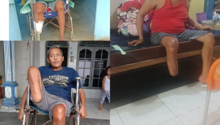Warga Perdagangan III yang Diamputasi Berharap Dinas Sosial Kabupaten Simalungun Tanggapi Permohonan Kaki Palsu